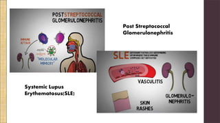 Post Streptococcal
Glomerulonephritis
Systemic Lupus
Erythematosus(SLE)
 