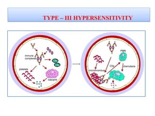 TYPE – III HYPERSENSITIVITY
 