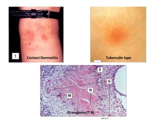 Contact Dermatitis Tuberculin type
Granuloma (T.B)
 