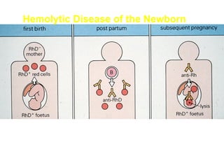 Hemolytic Disease of the Newborn

 