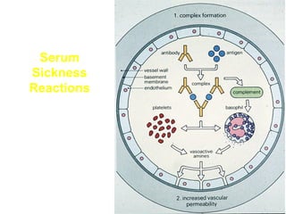 Serum
Sickness
Reactions

 