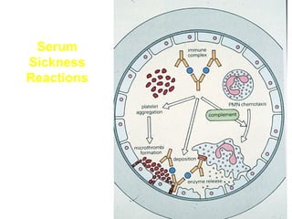 Serum
Sickness
Reactions

 