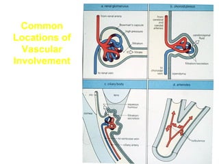 Common
Locations of
Vascular
Involvement

 