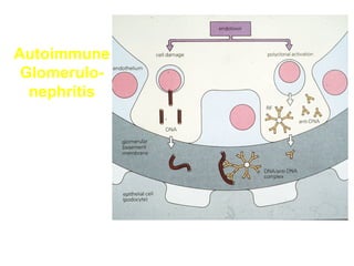 Autoimmune
Glomerulonephritis

 