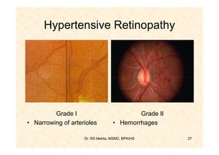 Hypertensive Retinopathy




         Grade I                          Grade II
• Narrowing of arterioles         • Hemorrhages

                    Dr. RS Mehta, MSND, BPKIHS       27
 