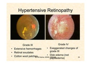 Hypertensive Retinopathy




          Grade III                         Grade IV
• Extensive hemorrhages          • Exaggerated changes of
• Retinal exudates                  grade III
• Cotton wool patchesRS Mehta, MSND,Disk edema (not
                    Dr.
                                 •
                                    BPKIHS                28
                                    papilledema)
 