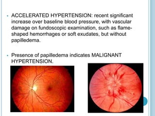  ACCELERATED HYPERTENSION: recent significant
increase over baseline blood pressure, with vascular
damage on fundoscopic examination, such as flame-
shaped hemorrhages or soft exudates, but without
papilledema.
 Presence of papilledema indicates MALIGNANT
HYPERTENSION.
 