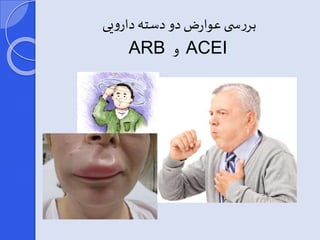 بررس ی عوارض دو دسته دارویی 
ARB و ACEI 
 