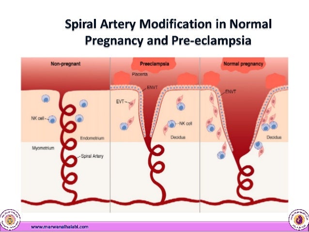 pregnancy induced hypertension and pre eclampsia Learn how to handle high blood pressure during pregnancy, which can lead to preeclampsia, how is mild gestational hypertension or preeclampsia without severe. pregnancy induced hypertension and pre eclampsia Learn how to handle high blood pressure during pregnancy, which can lead to preeclampsia, how is mild gestational hypertension or preeclampsia without severe.