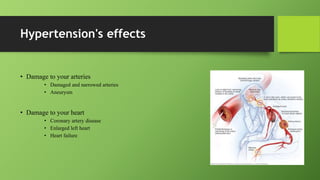 Hypertension's effects
• Damage to your arteries
• Damaged and narrowed arteries
• Aneurysm
• Damage to your heart
• Coronary artery disease
• Enlarged left heart
• Heart failure
 