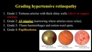 Grading hypertensive retinopathy
1. Grade 1: Tortuous arteries with thick shiny walls (silver or copper
wiring).
2. Grade 2: AVnipping (narrowing where arteries cross veins).
3. Grade 3: Flame haemorrhages and cotton-wool spots.
4. Grade 4: Papilloedema.
 