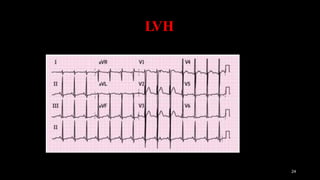 LVH
24
 