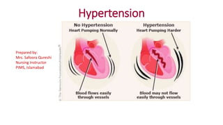 Hypertension
Prepared by:
Mrs. Safoora Qureshi
Nursing Instructor
PIMS, Islamabad
 