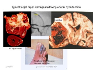 Typical target organ damages following arterial hypertension

                           CAD


                                                        stroke




     LV hypertrophy




                           Peripheral artery disease:
                           necrosis, gangrene

April 2013                   ghennersdorf SES FESC DGK
 