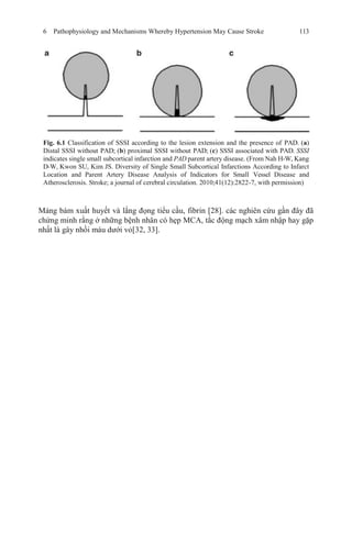 6 Pathophysiology and Mechanisms Whereby Hypertension May Cause Stroke 113
Fig. 6.1 Classification of SSSI according to the lesion extension and the presence of PAD. (a)
Distal SSSI without PAD; (b) proximal SSSI without PAD; (c) SSSI associated with PAD. SSSI
indicates single small subcortical infarction and PAD parent artery disease. (From Nah H-W, Kang
D-W, Kwon SU, Kim JS. Diversity of Single Small Subcortical Infarctions According to Infarct
Location and Parent Artery Disease Analysis of Indicators for Small Vessel Disease and
Atherosclerosis. Stroke; a journal of cerebral circulation. 2010;41(12):2822-7, with permission)
Mảng bám xuất huyết và lắng đọng tiểu cầu, fibrin [28]. các nghiên cứu gần đây đã
chứng minh rằng ở những bệnh nhân có hẹp MCA, tắc động mạch xâm nhập hay gặp
nhất là gây nhồi máu dưới vỏ[32, 33].
 