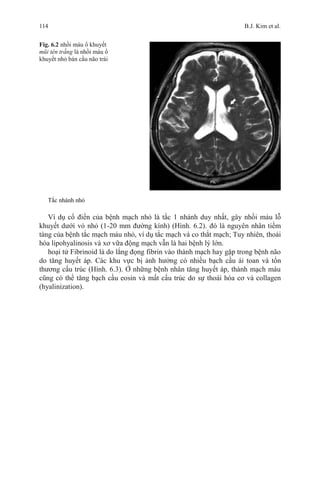 114 B.J. Kim et al.
Fig. 6.2 nhồi máu ổ khuyết
mũi tên trắng là nhồi máu ổ
khuyết nhỏ bán cầu não trái
Tắc nhánh nhỏ
Ví dụ cổ điển của bệnh mạch nhỏ là tắc 1 nhánh duy nhất, gây nhồi máu lỗ
khuyết dưới vỏ nhỏ (1-20 mm đường kính) (Hình. 6.2). đó là nguyên nhân tiềm
tàng của bệnh tắc mạch máu nhỏ, ví dụ tắc mạch và co thắt mạch; Tuy nhiên, thoái
hóa lipohyalinosis và xơ vữa động mạch vẫn là hai bệnh lý lớn.
hoại tử Fibrinoid là do lắng đọng fibrin vào thành mạch hay gặp trong bệnh não
do tăng huyết áp. Các khu vực bị ảnh hưởng có nhiều bạch cầu ái toan và tổn
thương cấu trúc (Hình. 6.3). Ở những bệnh nhân tăng huyết áp, thành mạch máu
cũng có thể tăng bạch cầu eosin và mất cấu trúc do sự thoái hóa cơ và collagen
(hyalinization).
 