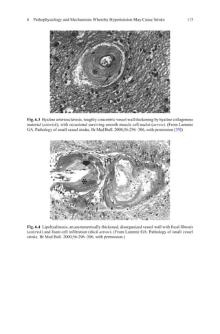 6 Pathophysiology and Mechanisms Whereby Hypertension May Cause Stroke 115
Fig. 6.3 Hyaline arteriosclerosis, roughly concentric vessel wall thickening by hyaline collagenous
material (asterisk), with occasional surviving smooth muscle cell nuclei (arrow). (From Lammie
GA. Pathology of small vessel stroke. Br Med Bull. 2000;56:296–306, with permission [39])
Fig. 6.4 Lipohyalinosis, an asymmetrically thickened, disorganized vessel wall with focal fibrosis
(asterisk) and foam cell infiltration (thick arrow). (From Lammie GA. Pathology of small vessel
stroke. Br Med Bull. 2000;56:296–306, with permission.)
 