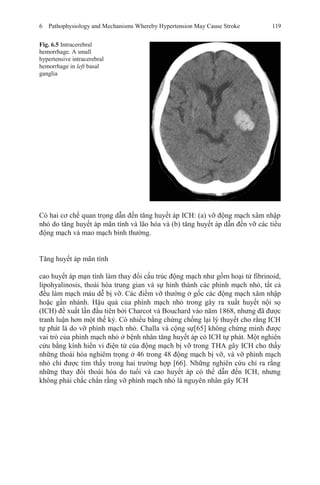 6 Pathophysiology and Mechanisms Whereby Hypertension May Cause Stroke 119
Fig. 6.5 Intracerebral
hemorrhage. A small
hypertensive intracerebral
hemorrhage in left basal
ganglia
Có hai cơ chế quan trọng dẫn đến tăng huyết áp ICH: (a) vỡ động mạch xâm nhập
nhỏ do tăng huyết áp mãn tính và lão hóa và (b) tăng huyết áp dẫn đến vỡ các tiểu
động mạch và mao mạch bình thường.
Tăng huyết áp mãn tính
cao huyết áp mạn tính làm thay đổi cấu trúc động mạch như gồm hoại tử fibrinoid,
lipohyalinosis, thoái hóa trung gian và sự hình thành các phình mạch nhỏ, tất cả
đều làm mạch máu dễ bị vỡ. Các điểm vỡ thường ở gốc các động mạch xâm nhập
hoặc gần nhánh. Hậu quả của phình mạch nhỏ trong gây ra xuất huyết nội sọ
(ICH) đề xuất lần đầu tiên bởi Charcot và Bouchard vào năm 1868, nhưng đã được
tranh luận hơn một thế kỷ. Có nhiều bằng chứng chống lại lý thuyết cho rằng ICH
tự phát là do vỡ phình mạch nhỏ. Challa và cộng sự[65] không chứng minh được
vai trò của phình mạch nhỏ ở bệnh nhân tăng huyết áp có ICH tự phát. Một nghiên
cứu bằng kính hiển vi điện tử của động mạch bị vỡ trong THA gây ICH cho thấy
những thoái hóa nghiêm trọng ở 46 trong 48 động mạch bị vỡ, và vỡ phình mạch
nhỏ chỉ được tìm thấy trong hai trường hợp [66]. Những nghiên cứu chỉ ra rằng
những thay đổi thoái hóa do tuổi và cao huyết áp có thể dẫn đến ICH, nhưng
không phải chắc chắn rằng vỡ phình mạch nhỏ là nguyên nhân gây ICH
 