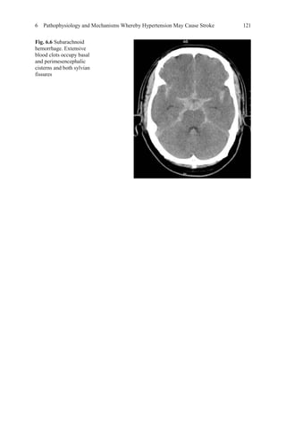 6 Pathophysiology and Mechanisms Whereby Hypertension May Cause Stroke 121
Fig. 6.6 Subarachnoid
hemorrhage. Extensive
blood clots occupy basal
and perimesencephalic
cisterns and both sylvian
fissures
 