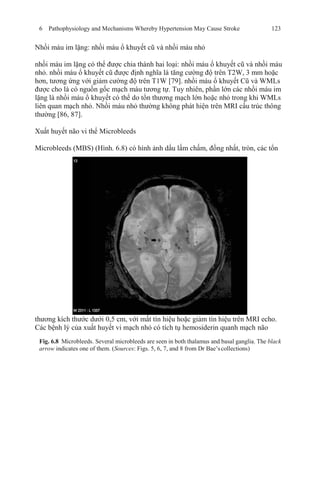 6 Pathophysiology and Mechanisms Whereby Hypertension May Cause Stroke 123
Nhồi máu im lặng: nhồi máu ổ khuyết cũ và nhồi máu nhỏ
nhồi máu im lặng có thể được chia thành hai loại: nhồi máu ổ khuyết cũ và nhồi máu
nhỏ. nhồi máu ổ khuyết cũ được định nghĩa là tăng cường độ trên T2W, 3 mm hoặc
hơn, tương ứng với giảm cường độ trên T1W [79]. nhồi máu ổ khuyết Cũ và WMLs
được cho là có nguồn gốc mạch máu tương tự. Tuy nhiên, phần lớn các nhồi máu im
lặng là nhồi máu ổ khuyết có thể do tổn thương mạch lớn hoặc nhỏ trong khi WMLs
liên quan mạch nhỏ. Nhồi máu nhỏ thường không phát hiện trên MRI cấu trúc thông
thường [86, 87].
Xuất huyết não vi thể Microbleeds
Microbleeds (MBS) (Hình. 6.8) có hình ảnh dấu lấm chấm, đồng nhất, tròn, các tổn
thương kích thước dưới 0,5 cm, với mất tín hiệu hoặc giảm tín hiệu trên MRI echo.
Các bệnh lý của xuất huyết vi mạch nhỏ có tích tụ hemosiderin quanh mạch não
Fig. 6.8 Microbleeds. Several microbleeds are seen in both thalamus and basal ganglia. The black
arrow indicates one of them. (Sources: Figs. 5, 6, 7, and 8 from Dr Bae’scollections)
 