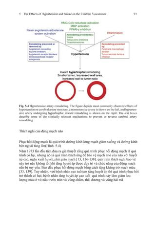 5 The Effects of Hypertension and Stroke on the Cerebral Vasculature 93
Fig. 5.4 Hypertensive artery remodeling. The figure depicts most commonly observed effects of
hypertension on cerebral artery structure, a normotensive artery is shown on the left, and hyperten-
sive artery undergoing hypertrophic inward remodeling is shown on the right. The text boxes
describe some of the clinically relevant mechanisms to prevent or reverse cerebral artery
remodeling
Thích nghi của động mạch não
Phục hồi động mạch là quá trình đường kính lòng mạch giảm xuống và đường kính
bên ngoài tăng lên(Hình. 5.4)
Năm 1973 lần đầu tiên đưa ra giả thuyết rằng quá trình phục hồi động mạch là quá
trình có hại, nhưng nó là quá trình thích ứng để bảo vệ mạch nhỏ của não với huyết
áp cao, ngăn xuất huyết, phù giãn mạch [13, 136-138]. quá trình thích nghi bảo vệ
này trở nên không tốt khi tăng huyết áp được duy trì và chức năng của động mạch
não bị suy yếu. Ban đầu phục hồi động mạch bằng cách tăng kháng trở mạch máu
[33, 139]. Tuy nhiên, với bệnh nhân cao tuổicos tăng huyết áp thì quá trình phục hồi
trở thành có hại; bệnh nhân tăng huyết áp cao tuổi quá trình này làm giảm lưu
lượng máu ở vỏ não trước trán và vùng chẩm, thái dương và vùng hải mã
 