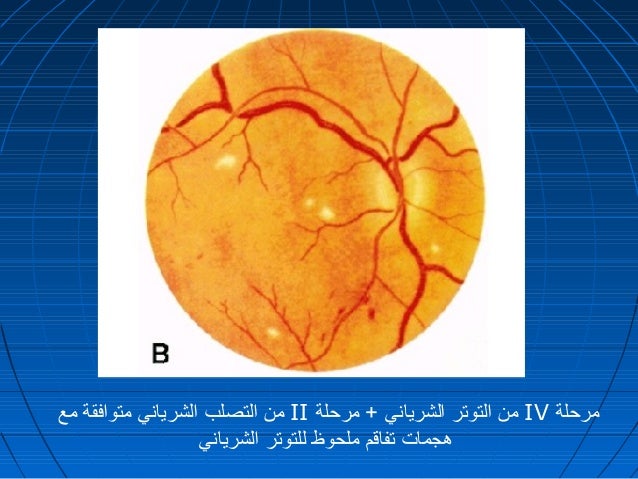 Hypertension And The Eye Dr Hussin Zenab
