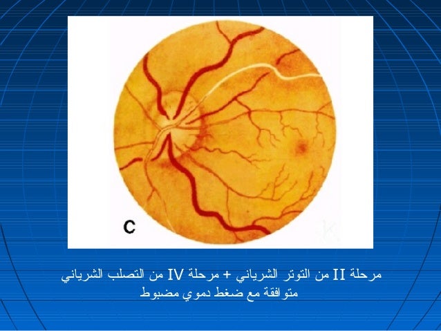 Hypertension And The Eye Dr Hussin Zenab
