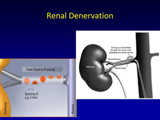 Renal Denervation
 