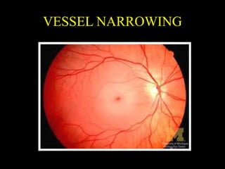 VESSEL NARROWING
 