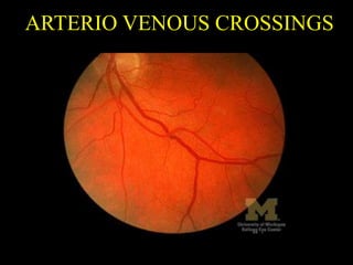 ARTERIO VENOUS CROSSINGS
 