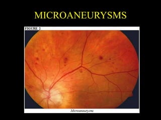 MICROANEURYSMS
 
