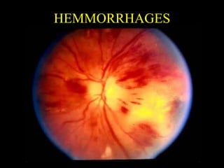 HEMMORRHAGES
 