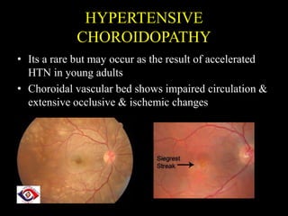 HYPERTENSIVE
CHOROIDOPATHY
• Its a rare but may occur as the result of accelerated
HTN in young adults
• Choroidal vascular bed shows impaired circulation &
extensive occlusive & ischemic changes
 