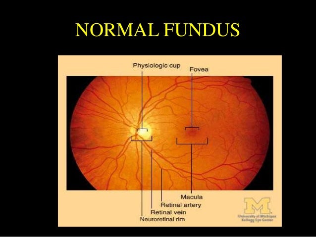 Hypertension & HYPERTENSIVE RETINOPATHY