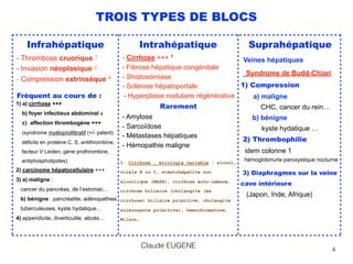 4
TROIS TYPES DE BLOCS
Infrahépatique
- Thrombose cruorique 1 
- Invasion néoplasique 2 
- Compression extrinsèque 3 
Fréquent au cours de : 
1) a) cirrhose +++ 
b) foyer infectieux abdominal 4 
c) affection thrombogène +++ 
(syndrome myéloprolifératif (+/- patent) 
déficits en protéine C, S, antithrombine,  
facteur V Leiden, gène prothrombine, 
antiphospholipides) 
2) carcinome hépatocellulaire +++  
3) a) maligne :  
cancer du pancréas, de l’estomac… 
b) bénigne : pancréatite, adénopathies 
tuberculeuses, kyste hydatique…
4) appendicite, diverticulite, abcès…
Intrahépatique
- Cirrhose +++ 1
- Fibrose hépatique congénitale
- Shistosomiase
- Sclérose hépatoportale
- Hyperplasie nodulaire régénérative 
Rarement
- Amylose
- Sarcoïdose
- Métastases hépatiques
- Hémopathie maligne
1. Cirrhose : étiologie variable : alcool,
virale B ou C, stéatohépatite non
alcoolique (NASH), cirrhose auto-immune,
cirrhose biliaire (cholangite (ex
cirrhose) biliaire primitive, cholangite
sclérosante primitive), hémochromatose,
Wilson…
Suprahépatique
Veines hépatiques  
Syndrome de Budd-Chiari
1) Compression 
a) maligne 
CHC, cancer du rein… 
b) bénigne 
kyste hydatique …
2) Thrombophilie
idem colonne 1
hémoglobinurie paroxystique nocturne
3) Diaphragmes sur la veine 
cave intérieure 
(Japon, Inde, Afrique) 
Claude EUGENE
 
