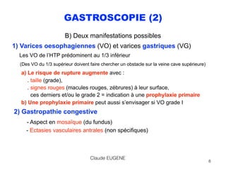 GASTROSCOPIE (2)
B) Deux manifestations possibles
1) Varices oesophagiennes (VO) et varices gastriques (VG) 
Les VO de l’H...