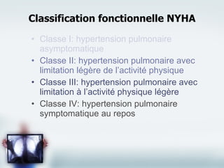 Classification fonctionnelle NYHA Classe I: hypertension pulmonaire asymptomatique Classe II: hypertension pulmonaire avec limitation légère de l’activité physique Classe III: hypertension pulmonaire avec limitation à l’activité physique légère Classe IV: hypertension pulmonaire symptomatique au repos 