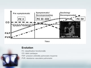 Evolution FC: classification fonctionnelle CO: débit cardiaque PAP: pression artérielle pulmonaire moyenne PVR: résistance vasculaire pulmonaire 