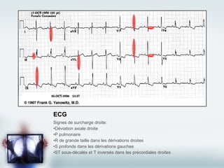 ECG Signes de surcharge droite: Déviation axiale droite P pulmonaire R de grande taille dans les dérivations droites S profonds dans les dérivations gauches ST sous-décalés et T inversés dans les précordiales droites 