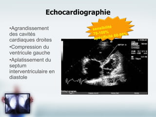 Agrandissement des cavités cardiaques droites Compression du ventricule gauche Aplatissement du septum interventriculaire en diastole Echocardiographie sensibilité 79-100% spécificité 60-98% 