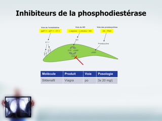 Inhibiteurs de la phosphodiestérase Molécule Produit Voie Posologie Sildenafil Viagra po 3x 20 mg/j Voie de l’endothéline Voie du NO Voie des prostacyclines ppET-1 – pET-1 – ET-1 L-arginine – L-citruline + NO AA – PGI2 Prostacycline NO ET-1 ET GTP cGMP PDE cAMP ET 