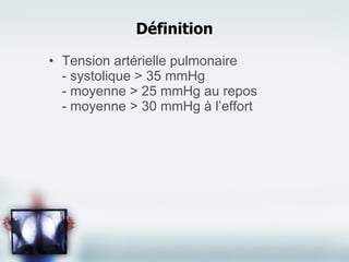 Définition Tension artérielle pulmonaire - systolique > 35 mmHg - moyenne > 25 mmHg au repos - moyenne > 30 mmHg à l’effort 