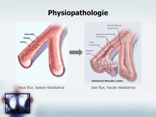 Physiopathologie haut flux, basse résistance bas flux, haute résistance 