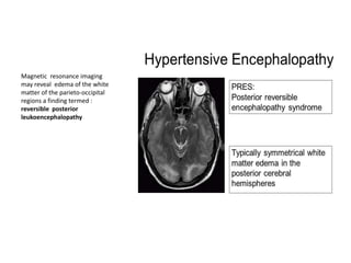 Magnetic resonance imaging
may reveal edema of the white
matter of the parieto-occipital
regions a finding termed :
reversible posterior
leukoencephalopathy
 