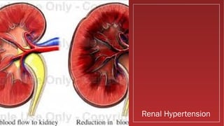 Renal Hypertension
 