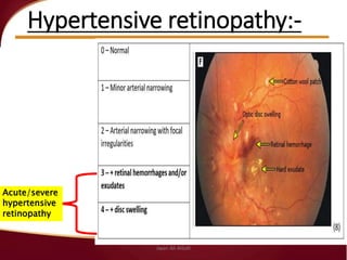 Hypertensive retinopathy:-
Acute/severe
hypertensive
retinopathy
Jwan Ali AlSofi
 