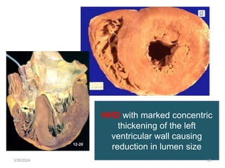 HHD with marked concentric
thickening of the left
ventricular wall causing
reduction in lumen size
3/26/2024 25
 