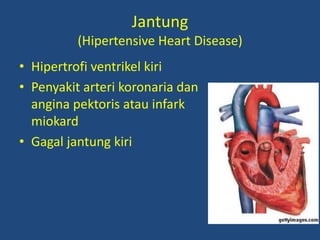 Jantung
(Hipertensive Heart Disease)
• Hipertrofi ventrikel kiri
• Penyakit arteri koronaria dan
angina pektoris atau infark
miokard
• Gagal jantung kiri
 