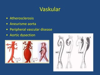 Vaskular
• Atherosclerosis
• Aneurisme aorta
• Peripheral vascular disease
• Aortic dysection
 