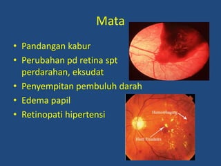 Mata
• Pandangan kabur
• Perubahan pd retina spt
perdarahan, eksudat
• Penyempitan pembuluh darah
• Edema papil
• Retinopati hipertensi
 
